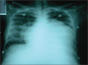– Chest X-ray on admission.