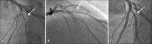 – Image of a ‘true’ coronary bifurcation lesion located in the proximal segment of the anterior descending artery (A), which showed dissection of the diagonal branch after predilation with a balloon-catheter (B), treated with a 2-stent (mini-crush) technique with good angiographic results (C).