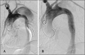 – Endovascular repair of the Stanford type B dissection. A, intraoperative aortography demonstrating a Stanford type B dissection in a bovine type II aortic arch. B, endovascular repair of a Stanford type B aortic dissection with the presence of a type Ia endoleak.