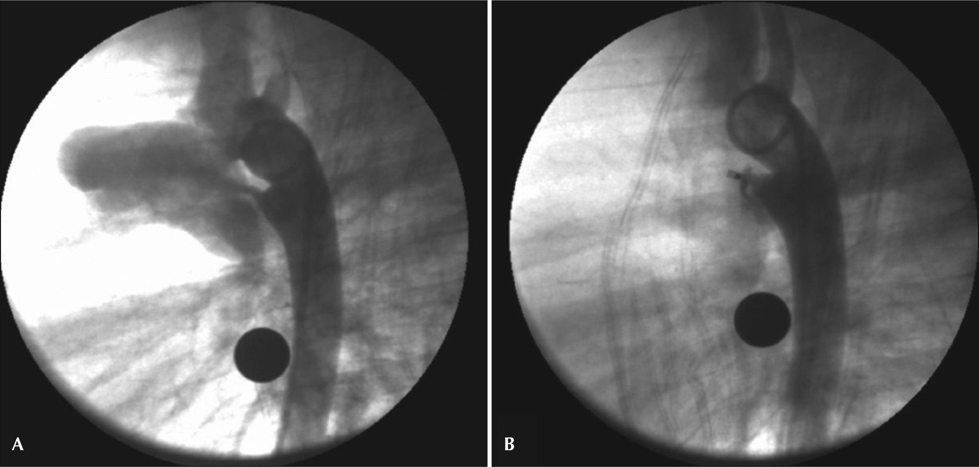 Percutaneous Occlusion of Patent Ductus Arteriosus with the Amplatzer ...