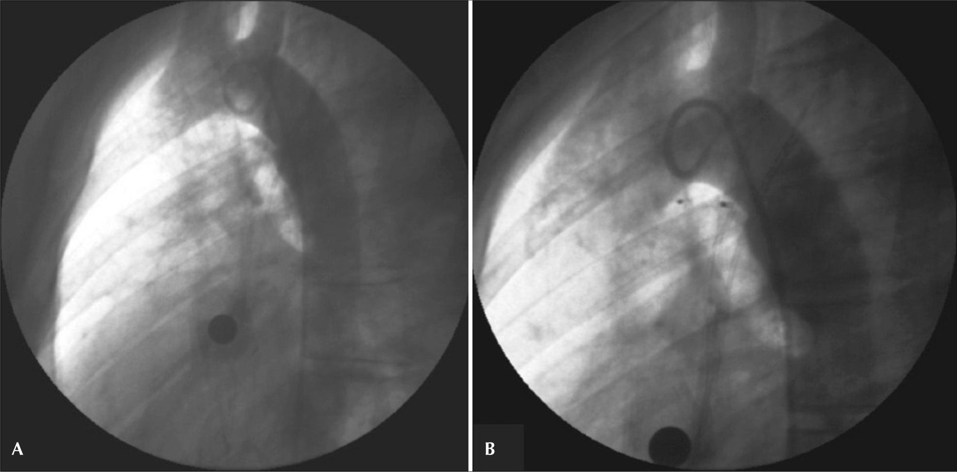Percutaneous Occlusion of Patent Ductus Arteriosus with the Amplatzer ...