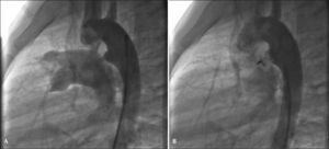 – Ductus arteriosus type A with a 2.8mm diameter at the pulmonary extremity. An 8mm Amplatzer® Vascular Plug II device was successfully employed. In A, initial aortography in left view. In B, control aortography showing the device well positioned within the ductus, with two discs inside the aortic ampulla and with no residual flow.