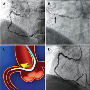 – In A, transradial coronary angiography showing critical stenosis and thrombus in the proximal right coronary artery. In B, 3.5/20mm Pro-Kinetic™ stent (white arrow) crushed in the proximal third of the right coronary artery and ‘mother’ (AL1 6F) and ‘child’ (the radiopaque spot of the GuideLiner™ 6F is identified by the black arrow) catheters. In C, schematic illustration representing image B. In D, the final angiographic control after 3.0/20mm Pro-Kinetic™ stent implanting.