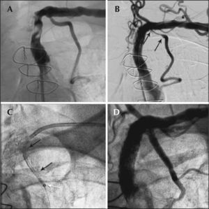 – In A, severe stenosis of the left subclavian artery before the origin of the left internal thoracic artery. In B, dissection of the ostium of the left internal thoracic artery (the limits of the dissection are between the black arrows) after a Dynamic™ 7.0/25mm stent implant in the left subclavian artery. In C, the GuideLiner™ in the proximal third of the left internal thoracic artery, with a distal radiopaque marker (white arrow) after the Pro-Kinetic™ 3.0/22mm first stent, which was displaced in the ostium (the stent limits are between the black arrows). In D, the final result after implantation of a second Pro Kinetic™ 3.0/13mm stent in the ostium of the left internal thoracic artery.