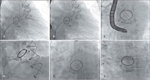 – In A, catheters in the left ventricle after moving past the mitral paravalvular orifice. In B, the positioning of the prostheses, with guidewire in the left ventricle. In C, placement of the prostheses, starting their release. In D, the release of the prostheses. In E and F, the final result.