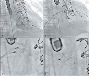 – In A, ventriculography in right anterior oblique view, showing mitral paravalvular regurgitation. In B, catheters in the left ventricle after moving past the mitral paravalvular orifice to start the prosthesis positioning. In C, the positioning of the prostheses and their release. In D, the final result.