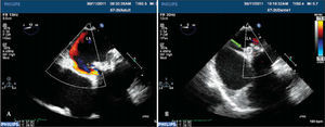 – Conventional transesophageal echocardiography images. In A, the periprosthetic defect with regurgitation into the left atrium. In B, after the Amplatzer™ Vascular Plug III (green arrow) device implantation, which is located between the prosthetic ring and the atrial wall, defect occlusion with the disappearance of periprosthetic regurgitation. LA=left atrium.