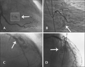 – In A, the left circumflex artery with an extraluminal crater (type I Ellis perforation). In B, the left circumflex artery with contrast extravasation into the pericardium with an orifice<1mm diameter (type II Ellis perforation). In C, left anterior descending artery showing rupture in its middle third, with diameter>1mm and significant extravasation of contrast outside the arterial lumen (type III Ellis perforation). In D, rupture of an important septal branch (left anterior descending artery branch) showing extravasation of contrast to the septum, with no extravasation of contrast to the pericardium (type IV Ellis perforation).