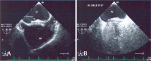 – Details of the control transesophageal echocardiography, six months after implantation. A, The prosthesis is well-positioned in the atrial septum. B, Bubble test, showing no bubbles passing into the left atrium, confirming the effectiveness of the device.