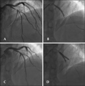 – In A, the initial angiogram demonstrating 80% lesion in the left anterior descending artery with an image that is suggestive of intracoronary thrombus. In B, Cypher™ 3.5 × 33mm stenting with guidewire to protect the lateral branch. In C, angiographic control immediately after implantation demonstrating severe injury to the diagonal branch origin. In D, post-dilation with kissing balloon.