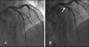 – In A, angiographic control after the kissing balloon. In B, final angiographic control without the guidewire in the diagonal branch demonstrating an equivocal image in proximal stent border (arrow).