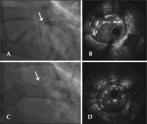 – In A, angiography demonstrating the guidewire behind the proximal stent struts (arrow). In B, IVUS demonstrating the catheteoutside the stent lumen. In C, angiography immediately after passag of a new guidewire inside the crushed struts (arrow). In D, IVUS demonstrating the correct guidewire position.