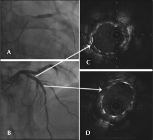 – In A, second Cypher™ stent implantation to correct the dissection of the proximal border of the first stent. In B, IVUS demonstrating good expansion and complete strut apposition at the overlap site. In C, final angiographic control. In D, IVUS of the left anterior descending artery at the bifurcation site.