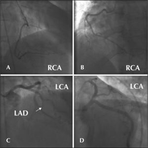 – Case 1. A) Right coronary artery in the right anterior oblique view. B) Right coronary artery in the left anterior oblique view. C) Left coronary artery in the right anterior oblique cranial view and the left anterior descending artery with total obstruction in the middle third (arrow). D) Left coronary artery in the left anterior caudal oblique view. RCA = right coronary artery, LCA = left coronary artery, LAD = left anterior descending artery.