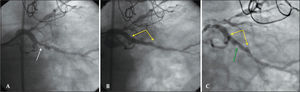 – Coronary angiography of the procedure and at 6 months. In A, angiography shows an eccentric lesion in the middle third of the left circumflex artery. The arrow points to the stenosis. In B, the final angiographic result after implantation of an everolimus-eluting stent of 3.5×23mm, post-dilated with a non-compliant balloon of 4×12mm up to 16atm. A satisfactory angiographic result without residual stenosis in the in-stent segment, no signs of injury at the borders and preserved distal epicardial flow (Thrombolysis In Myocardial Infarction – TIMI 3) were observed. Yellow arrows delimit the stent borders. In C, coronary angiography six months after the procedure with binary angiographic restenosis (stenosis diameter of 62%), focal, restricted to the in-stent segment is shown. Yellow arrows delimit the stent borders, and the green arrow points to the site of restenosis.