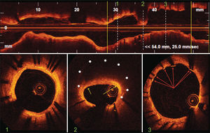 – Optical coherence tomography. In the top panel, longitudinal reconstruction of the left circumflex artery. The stent limits are identified by the yellow vertical bars. The white dotted vertical bars identify three representative images of the intrastent distal segment, site of restenosis and intrastent proximal segment corresponding to images of cross-sections of the vessel shown in the lower panel. Bottom Panel 1: distal segment of the stent showing a region with normal neointimal hyperplasia characterized by homogeneous circumferential distribution, a regular outline and high optical intensity. Bottom Panel 2: site of restenosis with eccentric distribution of neointimal tissue that has characteristics similar to those of a lipid plaque in de novo lesions. The white dots indicate the position of the stent struts that were not visualized due to important attenuation of the optical signal. The yellow arrows indicate areas of increased superficial brightness within the fibrous cap, suggesting the infiltration of macrophages/foam cells. Bottom Panel 3: proximal stent segment showing heterogeneous vascular healing with the presence of struts not covered by neointimal tissue (arrows).