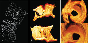 – Three-dimensional reconstruction of optical coherence tomography images. In A, three-dimensional reconstruction of the stent revealing discontinuity of the stent structure at the site of restenosis through important attenuation of the optical signal promoted by fatty infiltration of the neointima. In B, longitudinal images of the open vessel in two orthogonal planes showing the eccentricity and the three-dimensional distribution of the restenosis point. The black arrows indicate the site of restenosis. The asterisk indicates the shadow caused by the presence of the 0.014-inch guidewire. In C, fly-through visualisation of the coronary vessel showing the spatial distribution of neointimal tissue at the site of restenosis. The darker neointimal tissue at the point of restenosis compared with other regions of the vessel is the result of the attenuation of the light signal by lipid infiltration. The asterisk indicates the shadow caused by the presence of the guidewire.