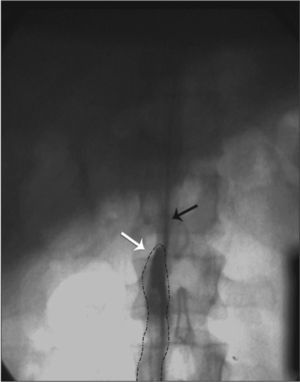 Angiography showing inferior vena cava agenesis (white arrow), with catheter progression through the hemiazygos vein (black arrow).