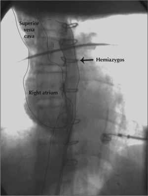 Schematic graph showing dilated hemiazygos vein draining into the common venous trunk, superior vena cava, and subsequently, into the right atrium.