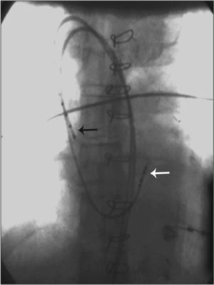 Positioning of diagnostic catheters in the right atrium (black arrow) and His bundle region (white arrow).