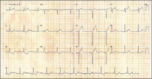 Admission ECG showing subepicardial lesion current in the antero-septal wall.