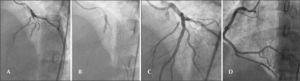 In A, B and C, anterior descending artery prior to, during, and after percutaneous coronary intervention. In D, right coronary artery free of thrombus after triple antiplatelet regimen for 24 hours.