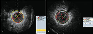 In A, anterior descending artery assessed using intracoronary ultrasound. In B, right coronary artery assessed using intracoronary ultrasound. of ischaemia recorded one the ECG must be treated first. In cases where the ECG is not clear, the culprit artery responsible for the larger at-risk myocardial territory should be treated first. 8