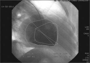 Left ventriculography: left posterior ventricle displaced downwards and backwards.