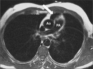 Chest magnetic resonance imaging showing the interposition of lung tissue between the aorta and pulmonary artery (arrow). Ao, aorta; PA, pulmonary artery.