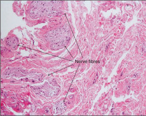 – Microscopic aspect of the control sample showing the presence of large nerve fibres. (200× magnification, hematoxylineosin staining).