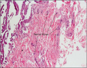 – Microscopic aspect after RF application with 5F solid tip catheter, at 8W for 60 seconds, showing neural lesion with multiple and small nerves. (200× magnification, hematoxylineosin staining).