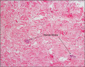 – Microscopic aspect after RF application with 5F solid-tip catheter at 8W for 120 seconds, showing neural lesion with rare and small nerves. (200× magnification, hematoxylin-eosin staining).