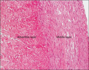 – Microscopic aspect after RF application with irrigated-tip catheter at 8W for 60 seconds, showing complete destruction of renal nerves and preserved middle layer. (200× magnification, hematoxylin-eosin staining).
