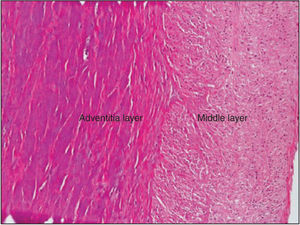 – Microscopic aspect after RF application with irrigated-tip catheter at 15W for 30 seconds showing complete destruction of renal nerves and affected middle layer. (200× magnification, hematoxylin-eosin staining).