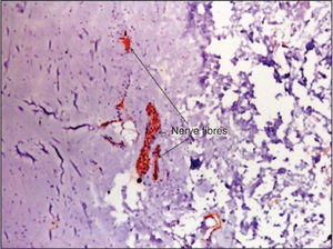 – Microscopic aspect after immune histochemical technique with S-100 protein showing the presence of small and scarce nerve fibres.