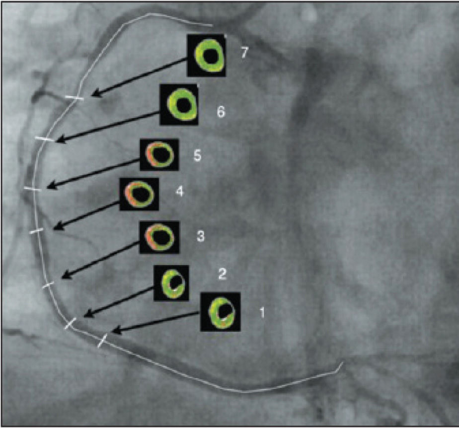 Association between Vascular Remodelling and Necrotic Core in Coronary ...