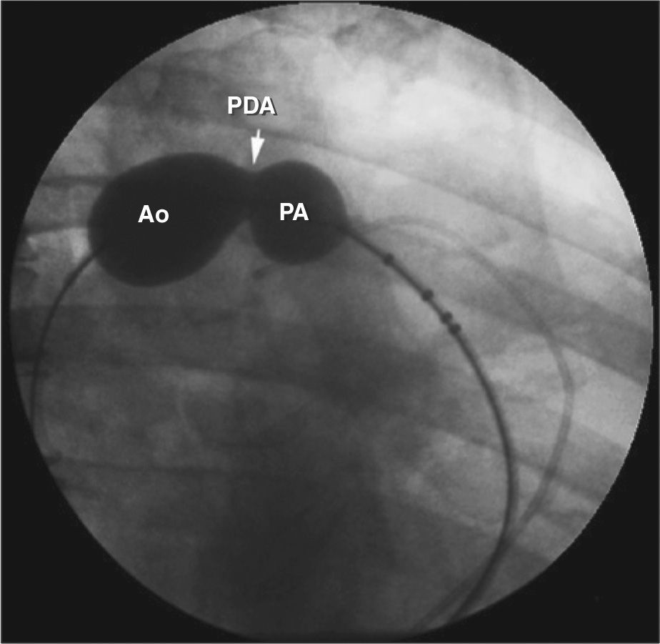 Pda Closure Incision Specific Aspects of Percutaneous Closure of Patent Ductus Arteriosus in ...