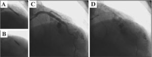 – In A, direct implantation of a 4.0×24mm Liberté™ stent in the middle third of the left anterior descending artery up to 12atm. In B, post-dilation with 4.0×10mm Hiryu® balloon catheter up to 18atm. In C and D, control angiography showing coronary rupture in the middle third of the left anterior descending artery, with continuous extravasation of contrast filling the left ventricular cavity (Ellis type IV coronary perforation).