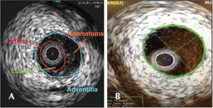 – In A, intracoronary ultrasound of the distal right coronary artery showing subintimal hematoma, causing significant luminal impairment. In B, intracoronary ultrasound of the proximal right coronary artery showing absence of atherothrombotic lesions.