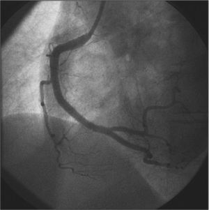 – Final control in the left anterior oblique view after the percutaneous coronary intervention with three everolimus-eluting stents to the right coronary artery and its branches.
