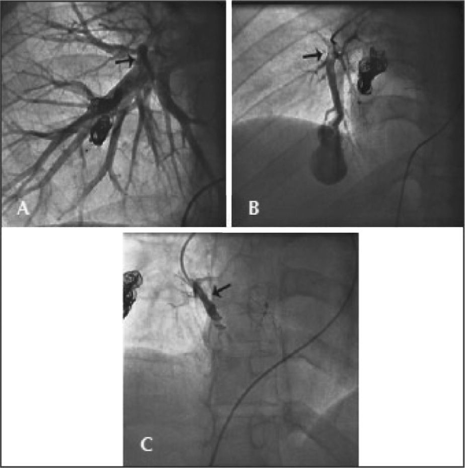 Percutaneous Embolisation of Pulmonary Arteriovenous Fistulae in ...