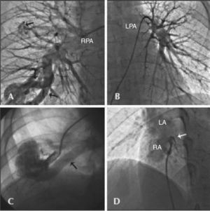 – In A, selective injection into the right pulmonary artery showing the presence of arteriovenous malformations, one of which was simple (arrow, upper portion) and another complex, with two adductor arteries (arrows, lower portion). In A, selective injection into the left pulmonary artery showing absence of fistulae. In C, selective injection into the adductor artery showing fistulous sac and involved vein (arrow). In D, injection into the patent foramen ovale in left cranial anterior oblique view showing passage of contrast from the right atrium to the left atrium (arrow). RPA, right pulmonary artery; LPA, left pulmonary artery; LA, left atrium; RA, right atrium.