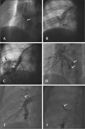 – In A, the immediate result after patent foramen ovale occlusion with Cardia prosthesis (arrow). In B, vascular plugs released in two adductor arteries of the large fistula in the right lung (arrows). In C, the immediate outcome showing residual flow after implantation of vascular plugs (arrows). In D, new procedure performed five days after implantation of additional Gianturco coils, using the plug as an anchor in the adductor arteries of the largest fistulous sac (arrows). In E and F, microfistula occlusion in middle lobe of the right lung with a Gianturco coil (arrow).