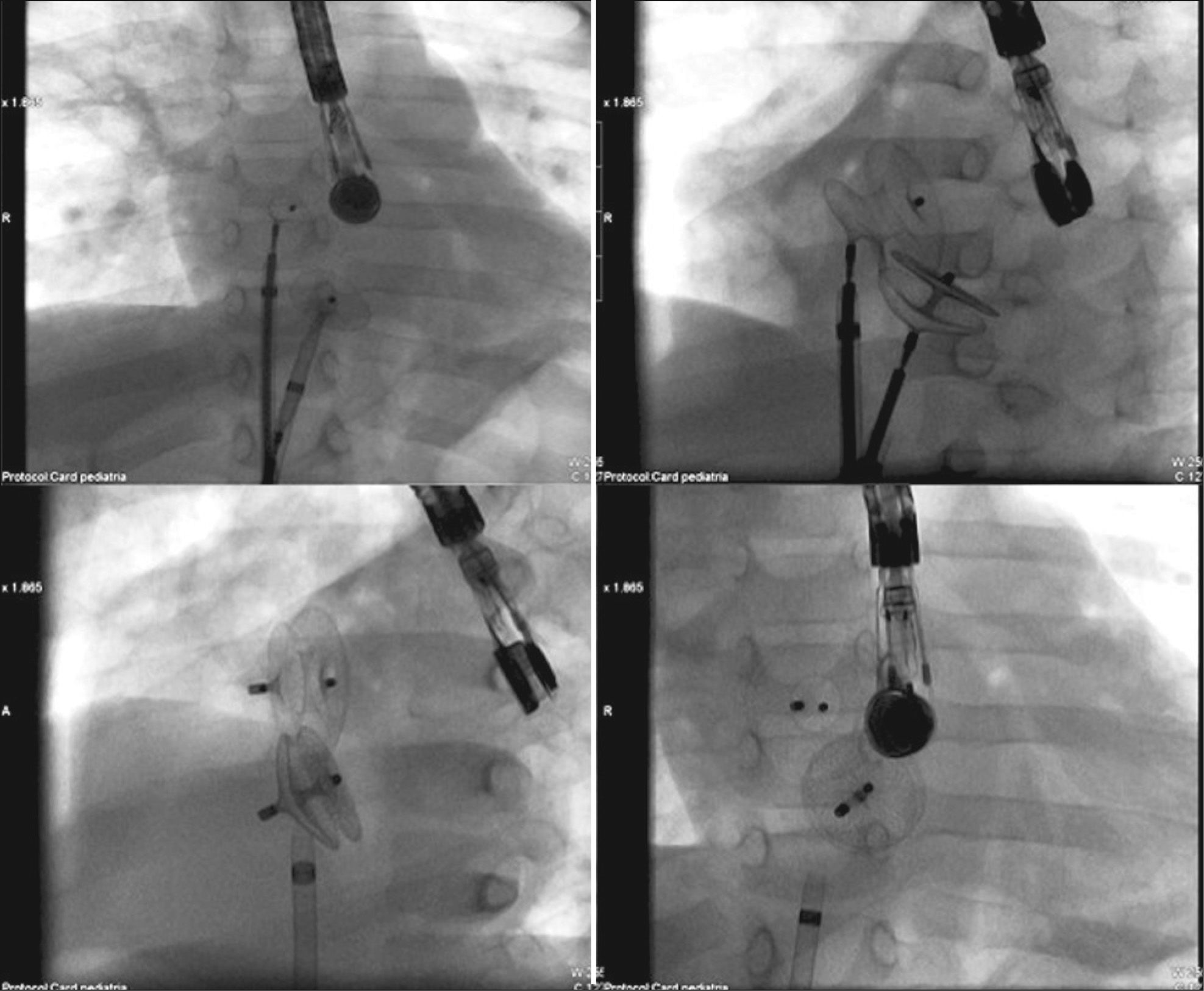 Patch Closure Feasibility, Safety, and Efficacy of Percutaneous Atrial Septal Defect ...