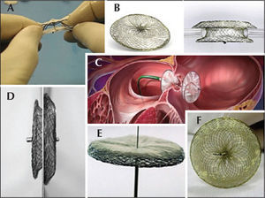 – Prostheses used: A) Cardia® Atriassept (CardioLogic Ltd.) B) Figulla® ASD (Occlutech International AB), C) Helex® ASD (Gore Medical Inc.), D) Amplatzer® ASO (St. Jude Medical, Inc.), E) Nit Occlud® ASD – R (PFM Medical Ag.), and F) Cera® (Lifetech Scientific).