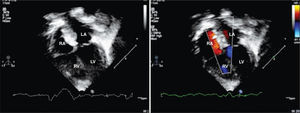 – Transthoracic echocardiography showing good positioning of the two prostheses implanted in the interatrial septum, with no residual shunt six months after percutaneous treatment, as shown by the color flow mapping. RA, right atrium, LA, left atrium, RV, right ventricle; LV, left ventricle.