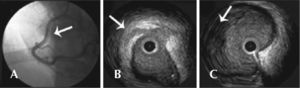 – In A, coronary angiography shows image suggestive of spontaneous dissection in the middle third of the right coronary artery (arrow), with normal distal flow. In B, intravascular ultrasound demonstrates intima flap (arrow). In C, intravascular ultrasound shows evidence of vessel wall hematoma (arrow).