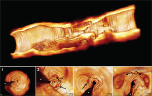– Three-dimensional reconstruction of optical coherence tomography images. In the top panel, three-dimensional image of the open vessel in the longitudinal direction, showing multiple orifices and trajectories along the stenosis. In the lower panel, fly-through images of the coronary in the proximal-distal direction with large septum (black asterisks), separating the vascular lumen into two major cavities, and presence of multiple channels (arrows) throughout the trajectory. The shadow produced by the metal guide is indicated by the white asterisks.