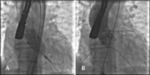 – (A) Release of Edwards SAPIEN XT valve after inflating the balloon catheter. (B) Implanted aortic valve.