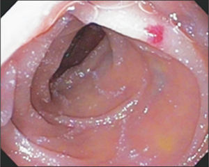 – Angiodysplastic lesion in the proximal duodenum.